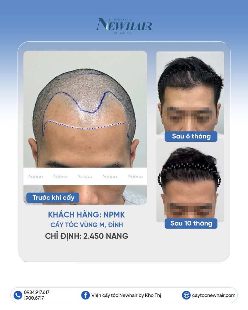 cấy tóc sau 6 tháng và 10 tháng