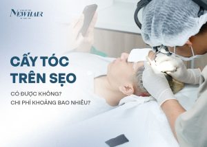 cấy tóc trên sẹo newhair