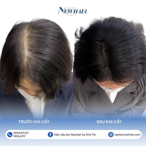 cấy tóc tự thân có hiệu quả không