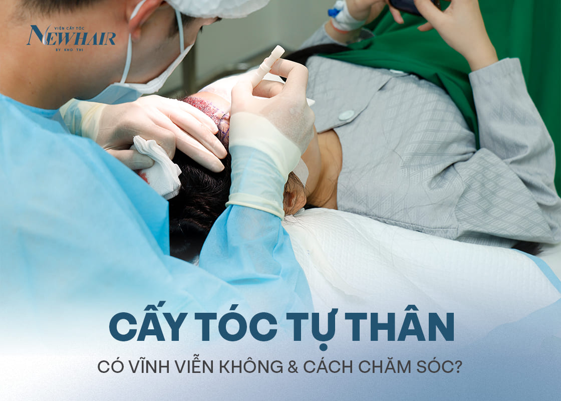 cấy tóc tự thân có vĩnh viễn không