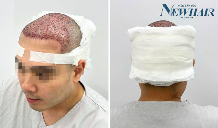 chăm sóc tóc sau cấy