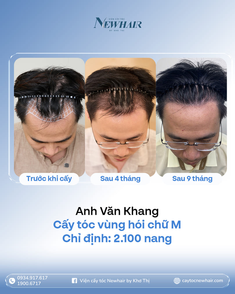 chi phí cấy tóc bao nhiêu tiền