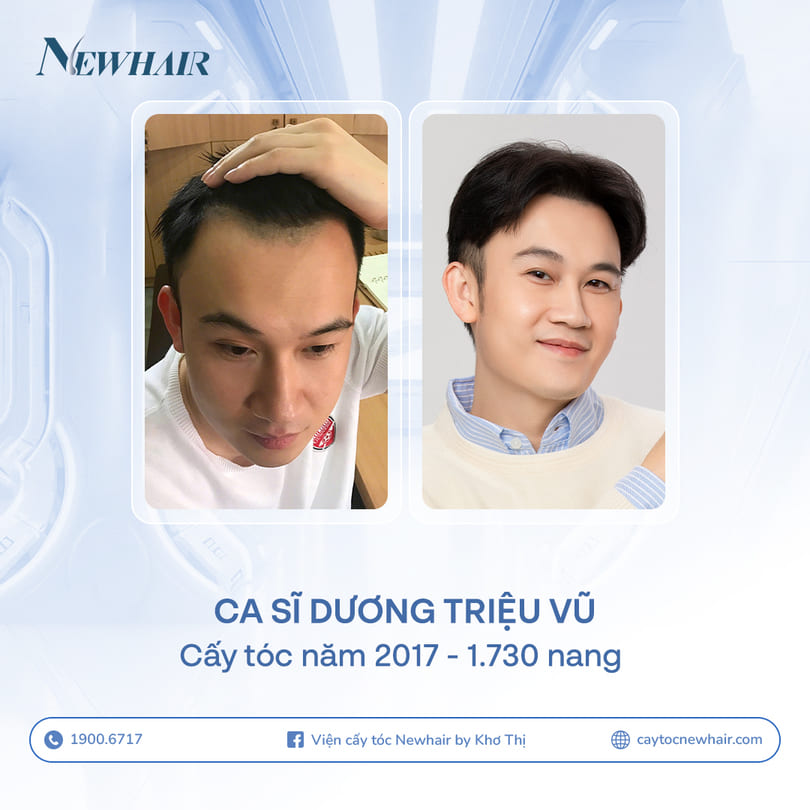 dương triệu vũ trước và sau khi cấy tóc