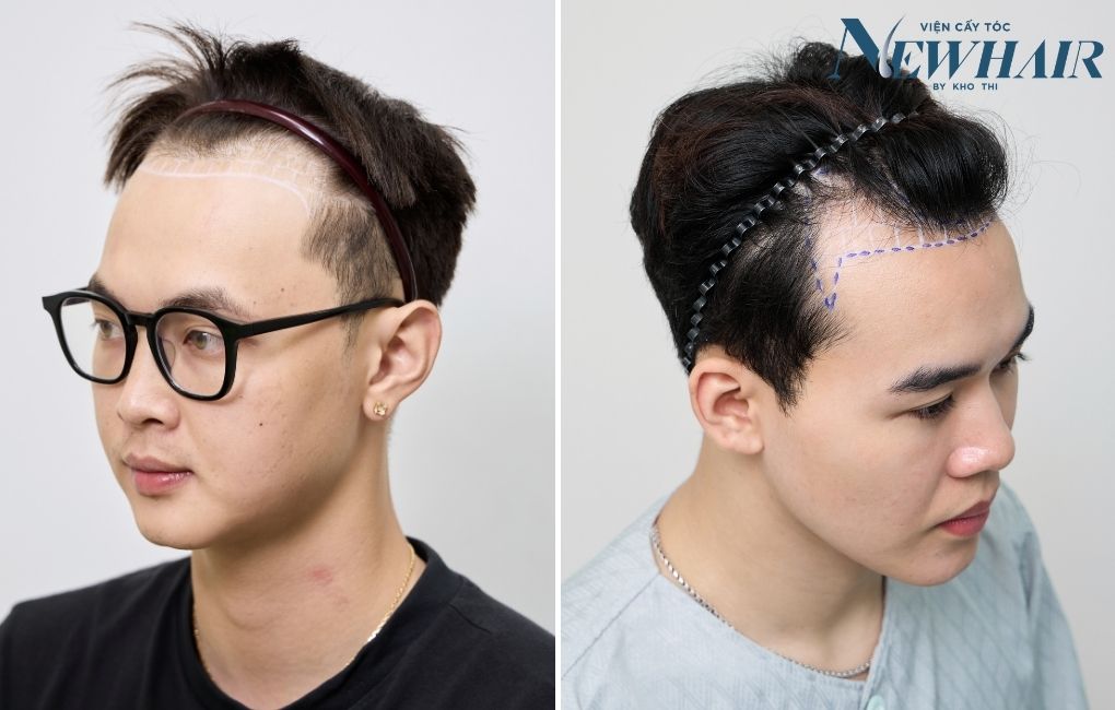 hói chữ m ở nam