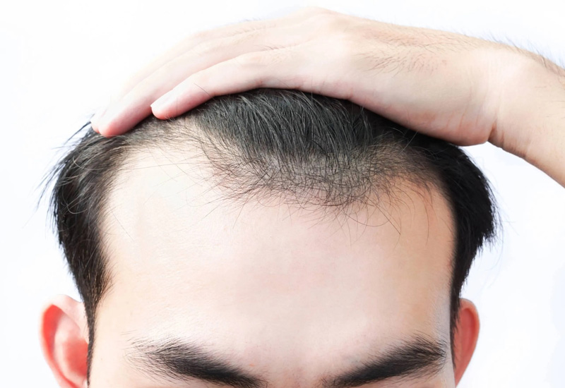 Rụng tóc ở nam giới do đâu 11 nguyên nhân rụng tóc ở nam