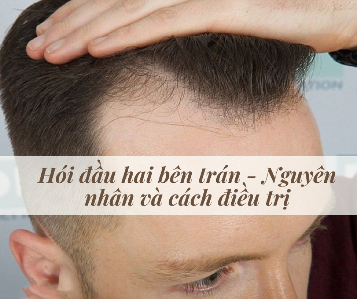 5+ Cách chữa trị rụng tóc dân gian hiệu quả nhất tại nhà! | Rungtoc.vn