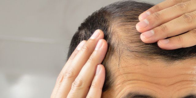 Bệnh hói đầu Nguyên nhân dấu hiệu cách điều trị và phòng ngừa