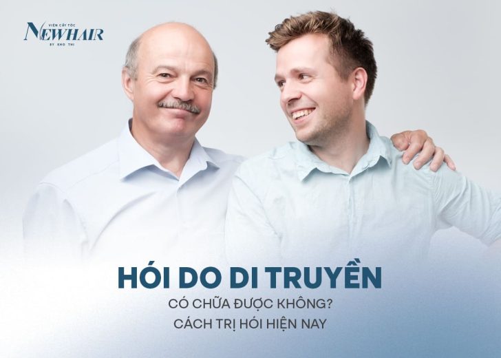 hói do di truyền có chữa được không