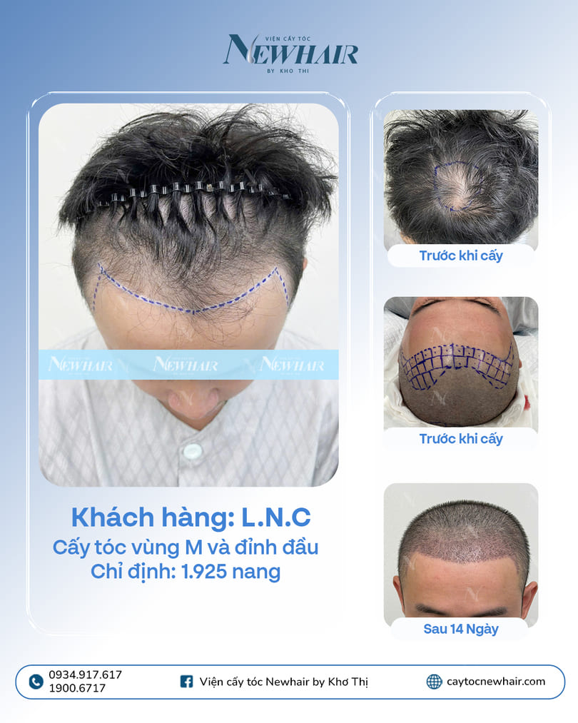 khách hàng cấy tóc hói chữ M