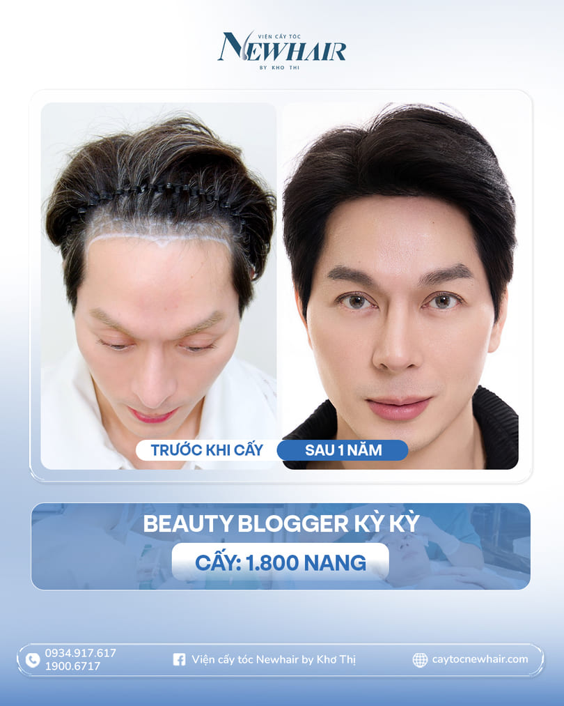kỳ kỳ trước và sau hạ đường chân tóc