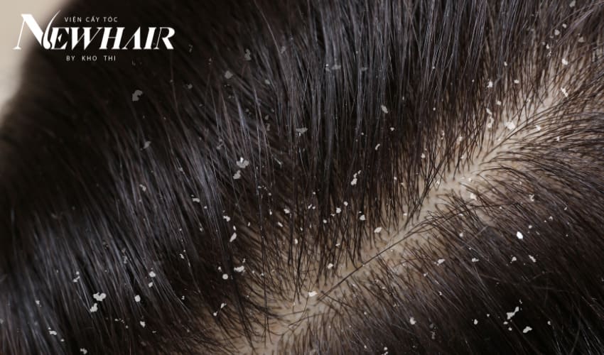 lợi ích ủ tóc bằng giấm táo