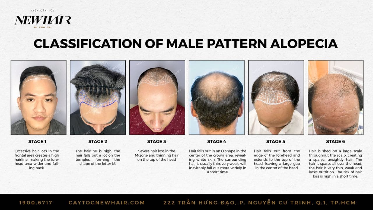 male pattern alopecia