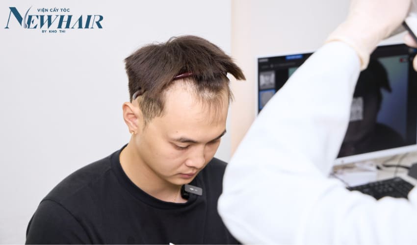 nguyên nhân gây hói chữ M