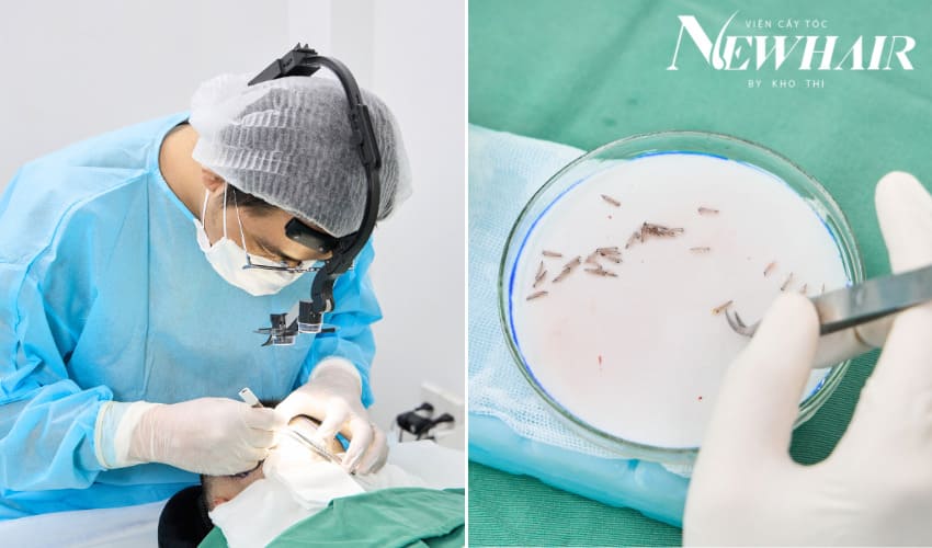 quy trình cấy tóc mất bao lâu