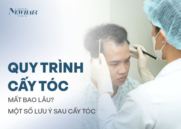 quy trình cấy tóc mất bao lâu