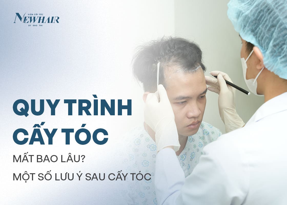 quy trình cấy tóc mất bao lâu