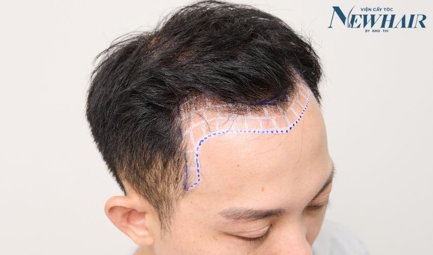 rụng tóc 2 bên thái dương