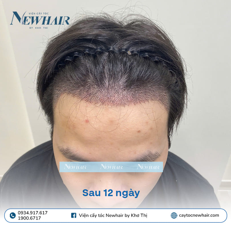 sau cấy 12 ngày