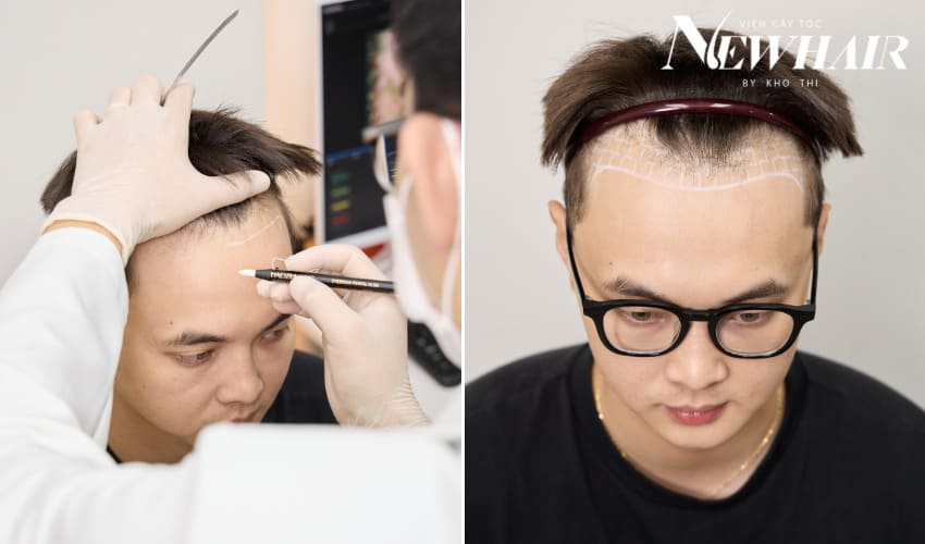 thăm khám khi cấy tóc