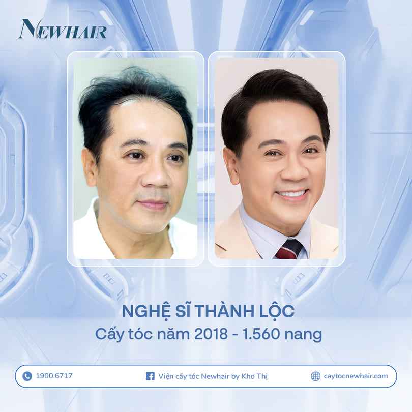 thành lộc trước và sau khi cấy tóc