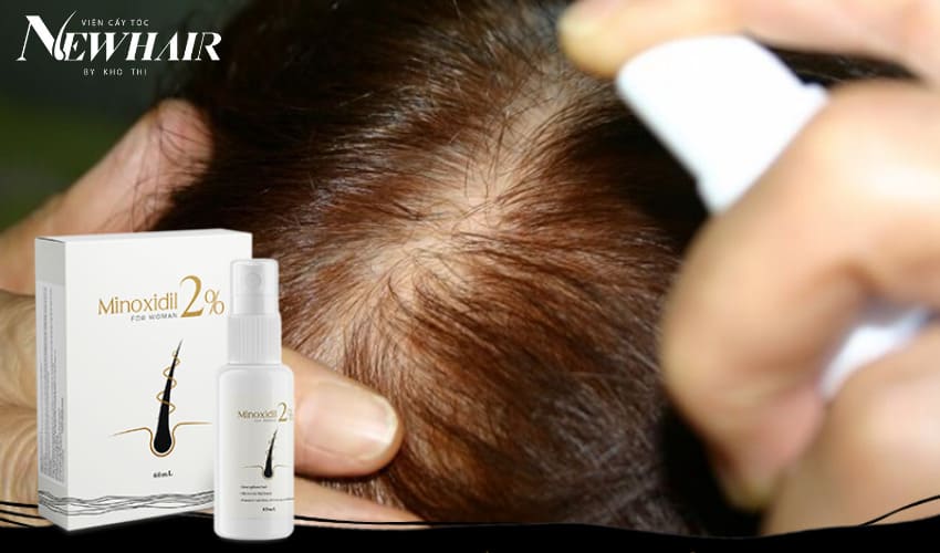 thuốc trị hói chữ m