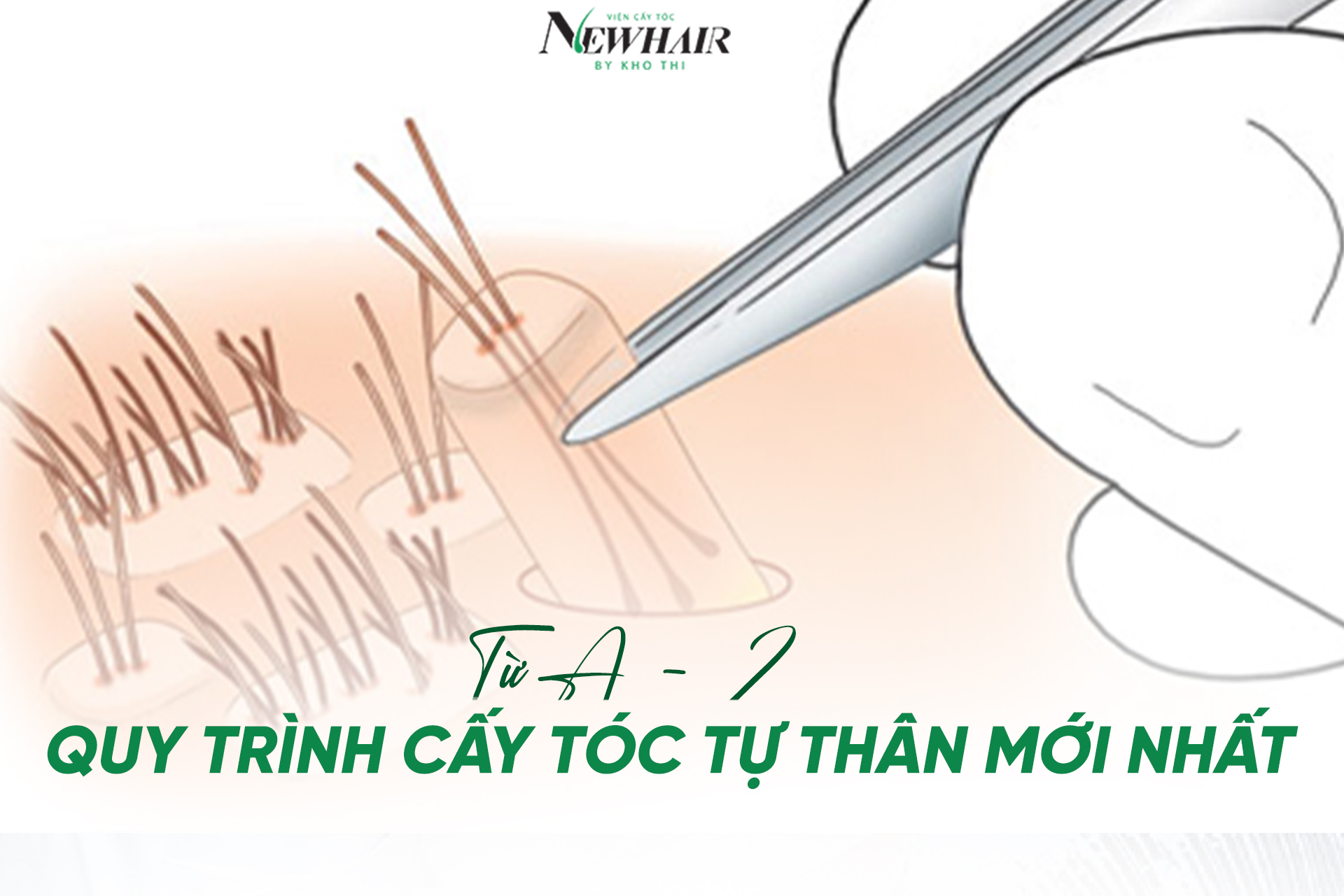 tu a - z quy trinh cay toc tu than moi nhat 2025