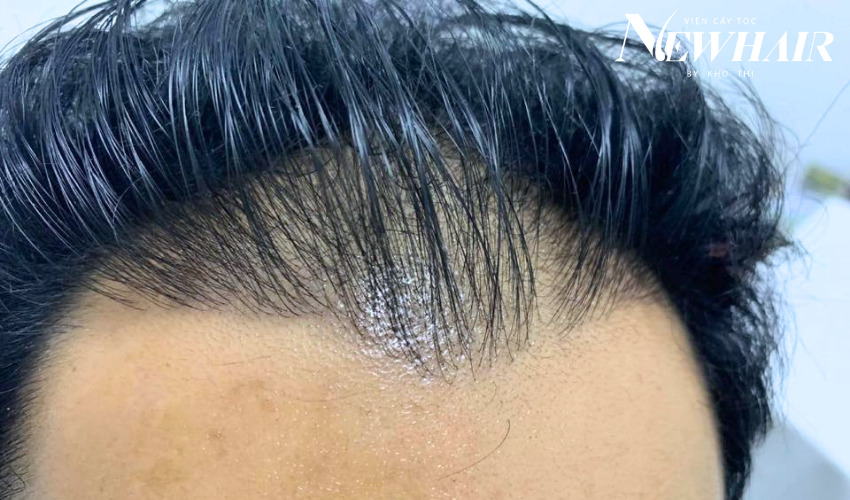 ưu điểm của cấy tóc sinh học