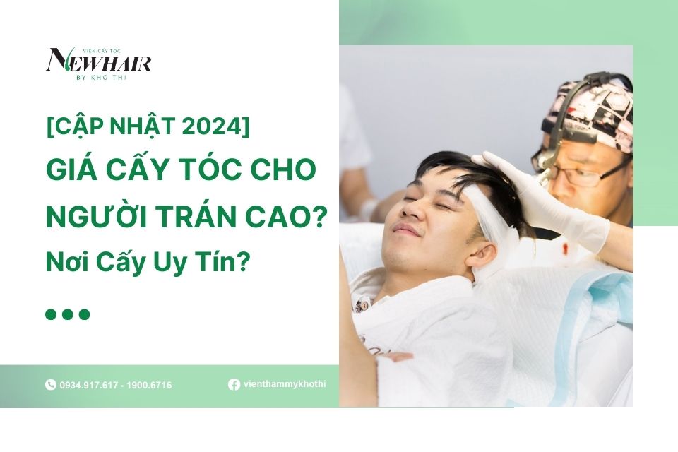 giá cấy tóc cho người trán cao