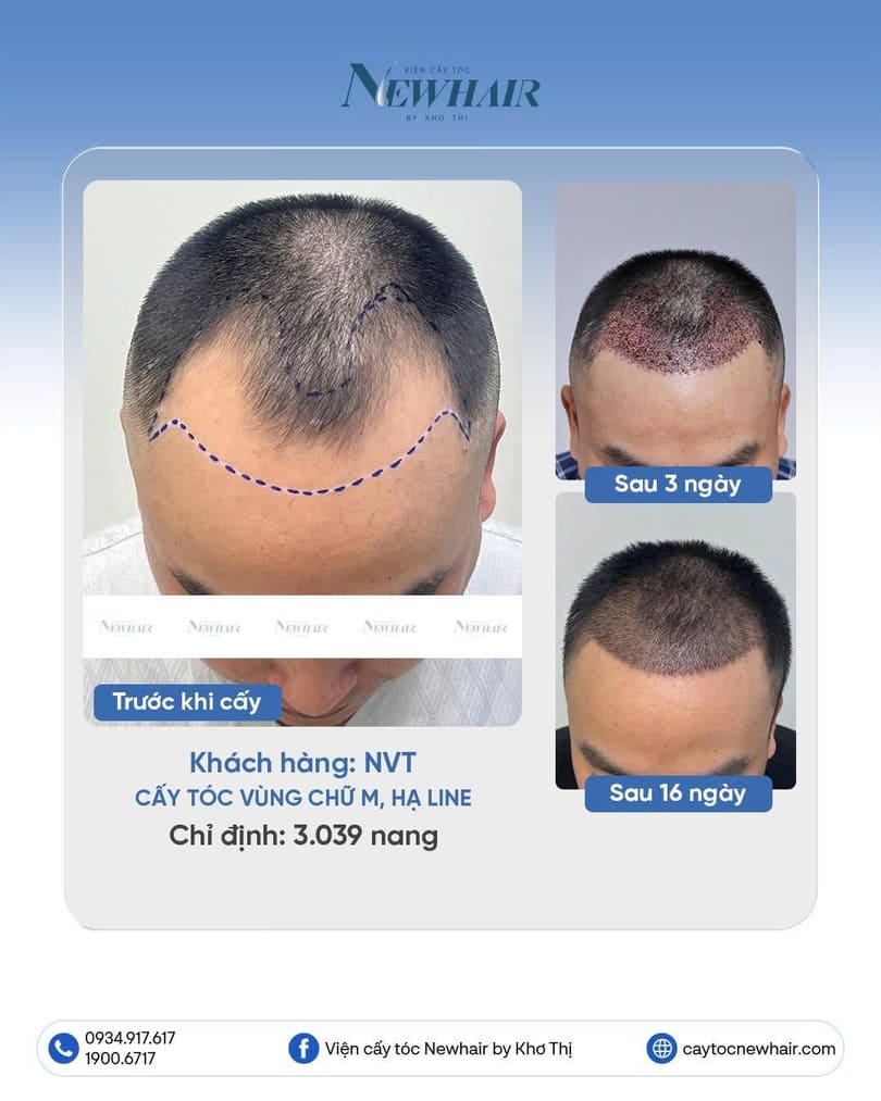 cấy tóc chữ m kết hợp hạ đường chân tóc