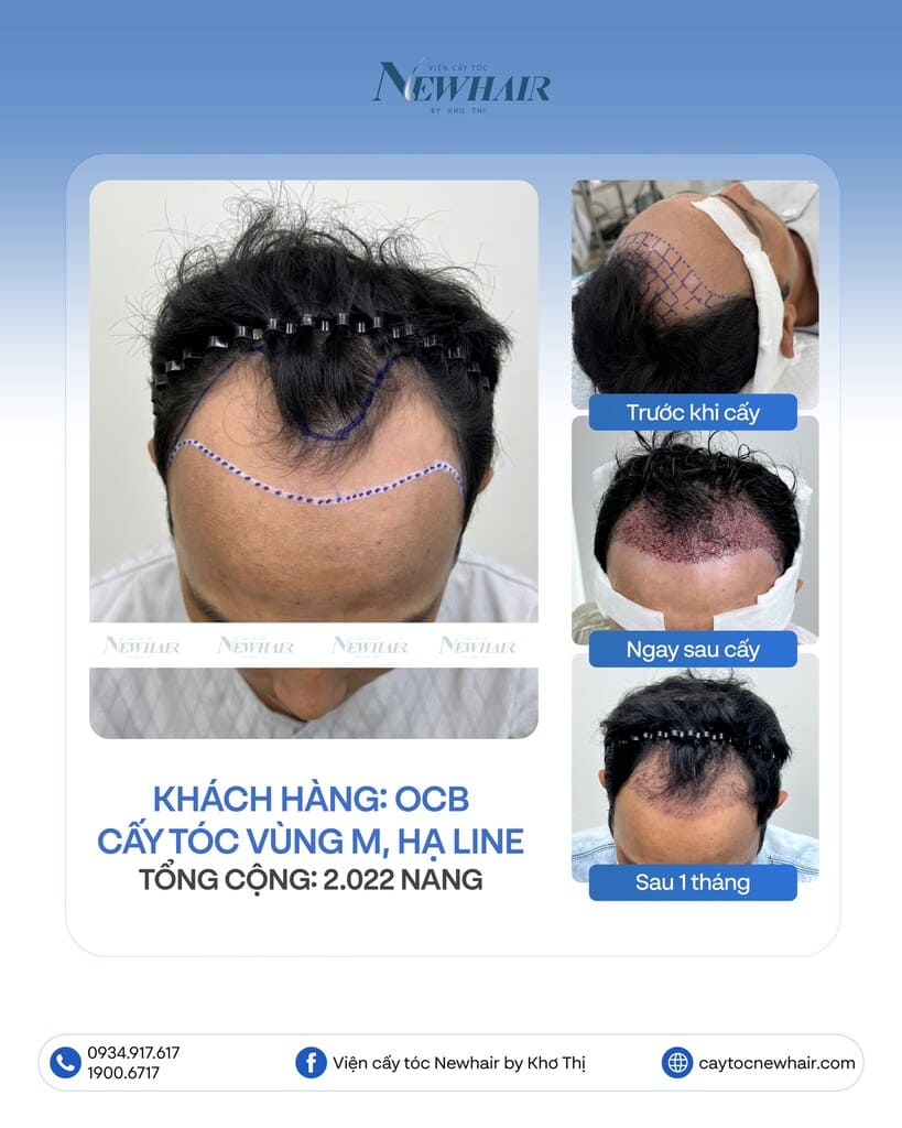 cấy tóc trán cao cho nam tại newhair