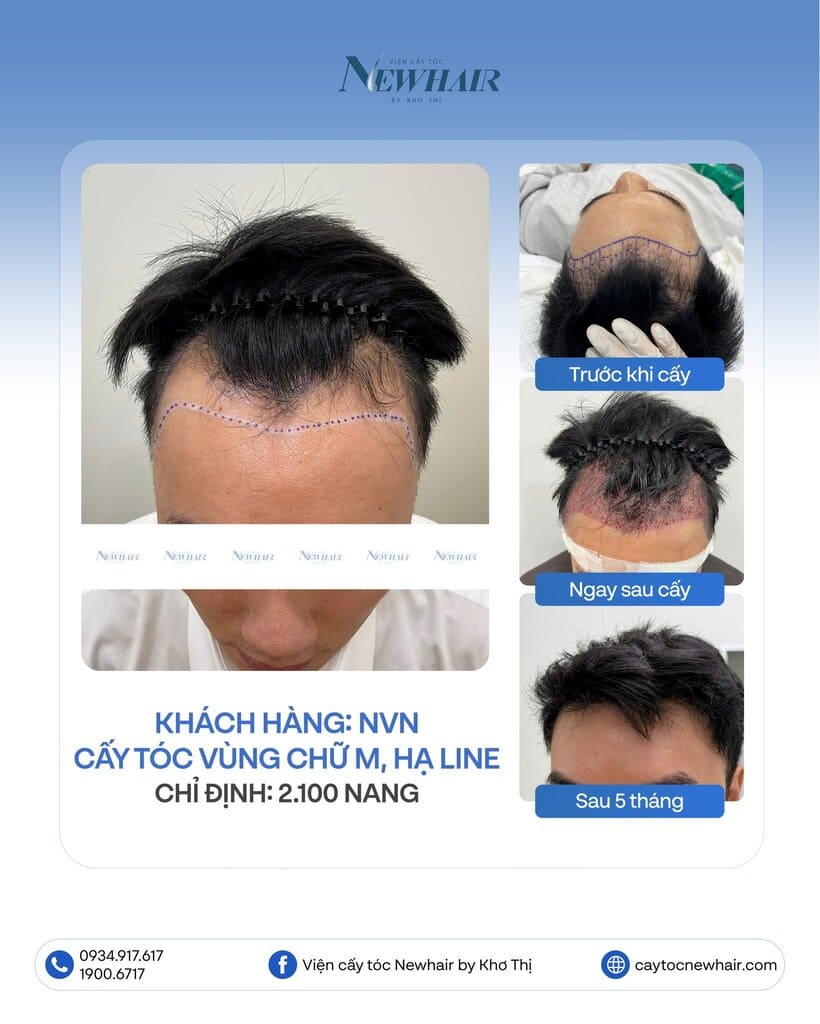 cấy tóc trán cao nam
