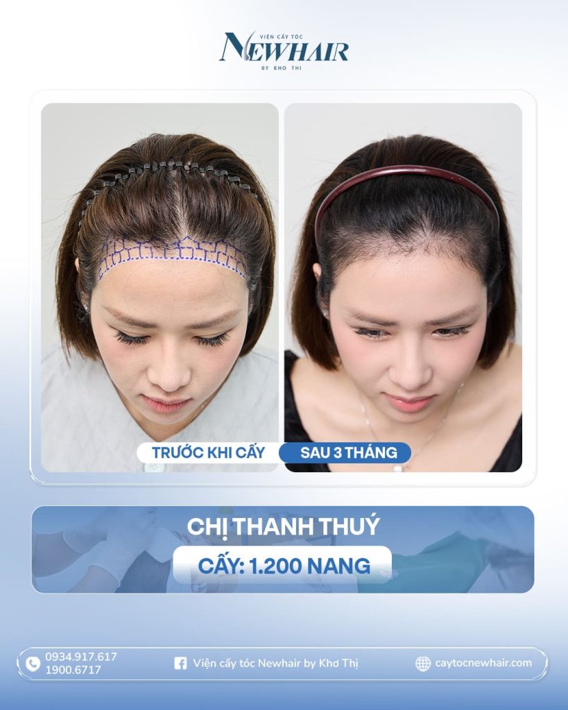 cấy tóc trán cao hạ đường chân tóc cho nữ