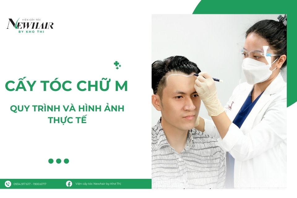 cấy tóc chữ M