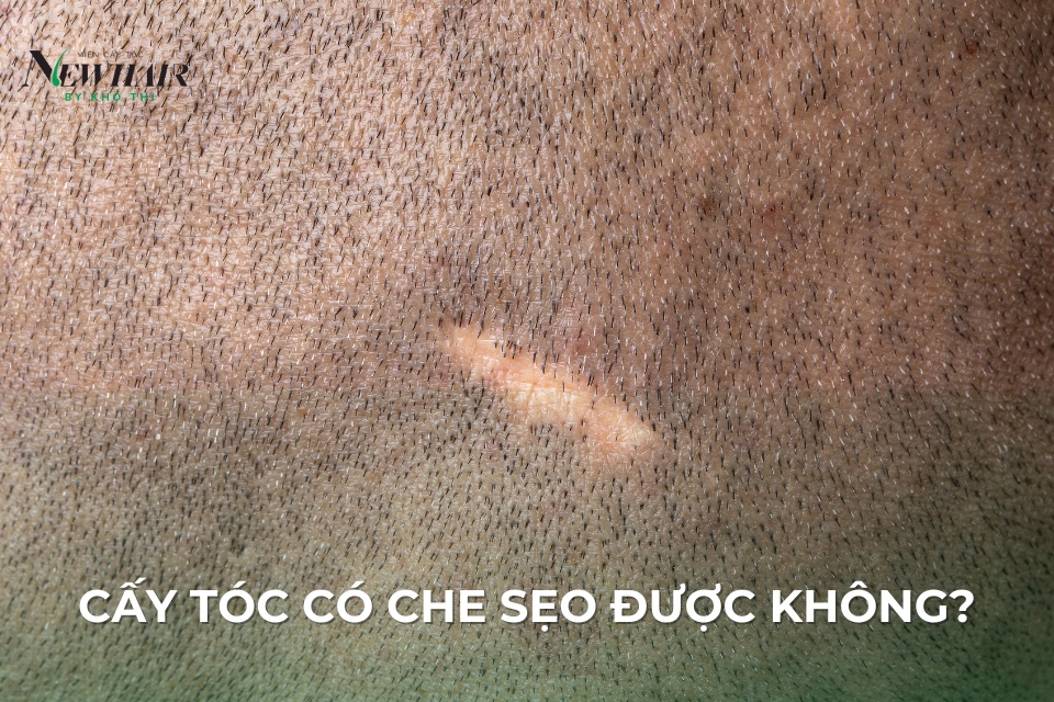 Cấy tóc che sẹo