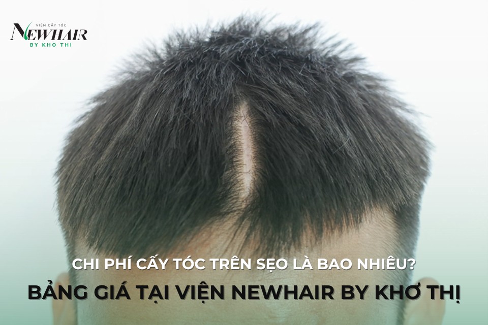 chi phí cấy tóc trên sẹo