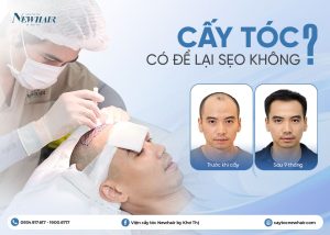 cấy tóc có để lại sẹo không