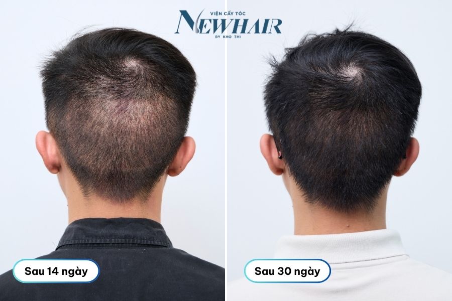 vùng hiến nang sau 30 ngày cấy