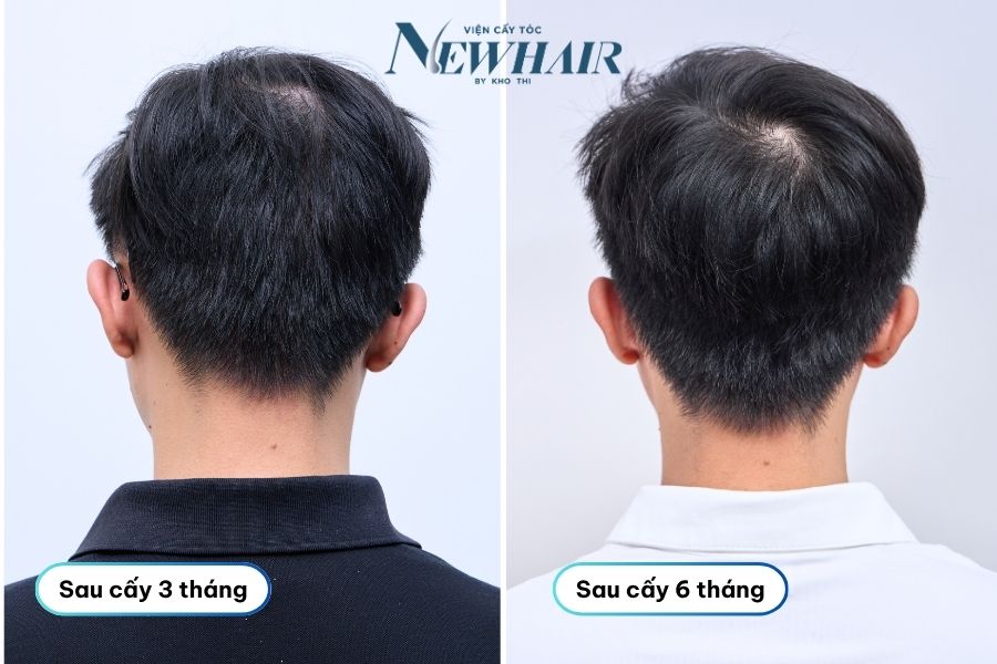 vùng hiến nang sau 6 tháng cấy