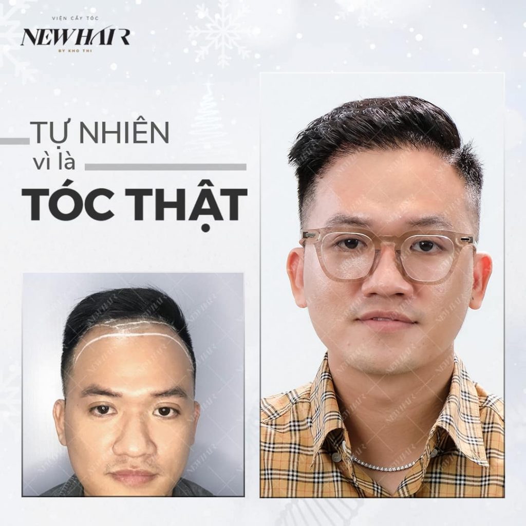 Cấy tóc tự thân Hair Balance