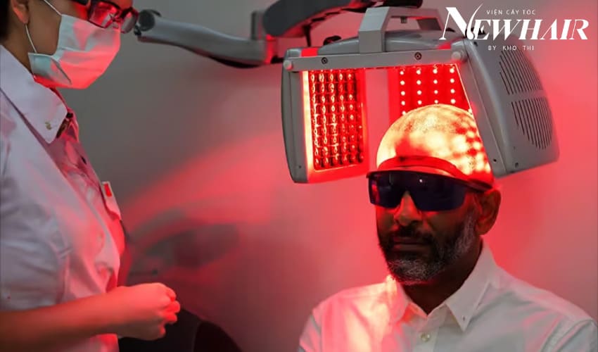 cách trị hói chữ m bằng laser