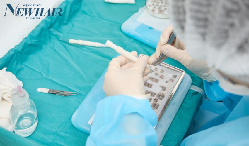 cách trị hói chữ m cấy tóc