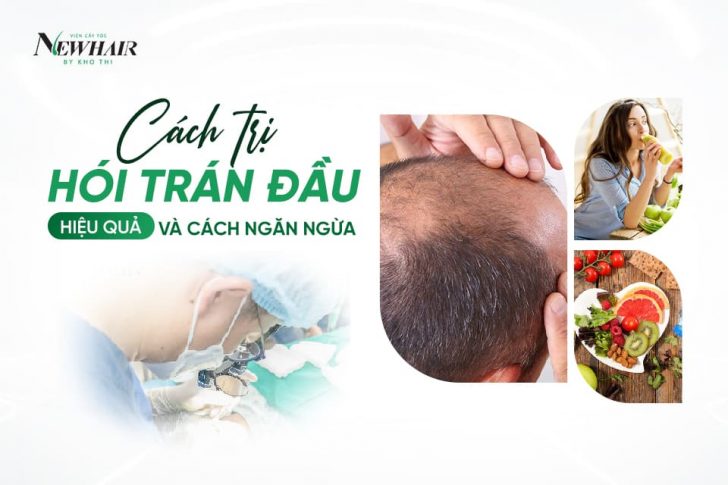 Cách trị hói trán đầu