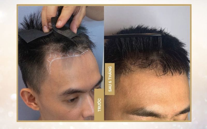 Địa chỉ điều trị uy tín và cam kết hiệu quả 100% - NewHair By Khơ Thị