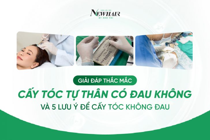 Cấy tóc tự thân có đau không