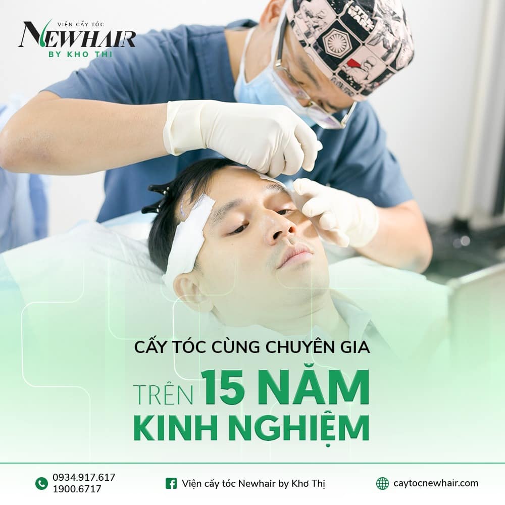 cấy tóc tự thân có tốt không