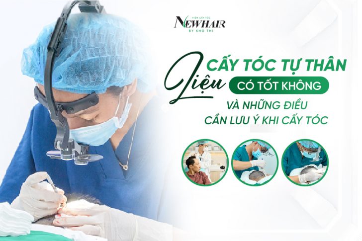 cấy tóc tự thân có tốt không