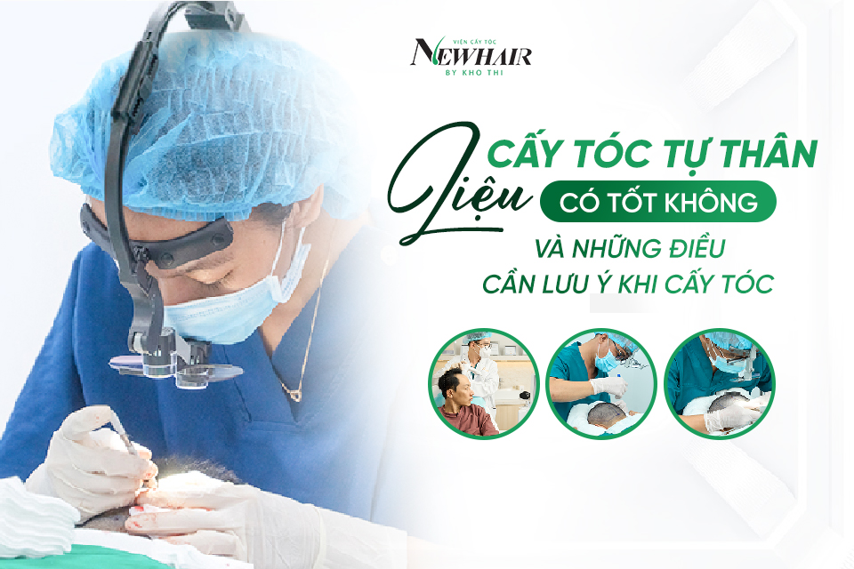 cấy tóc tự thân có tốt không