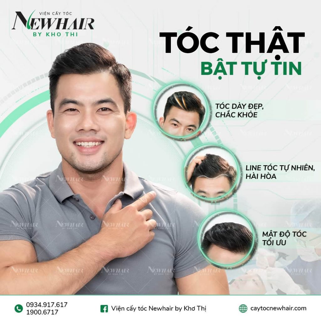 Cấy tóc tự thân ở đâu tốt nhất