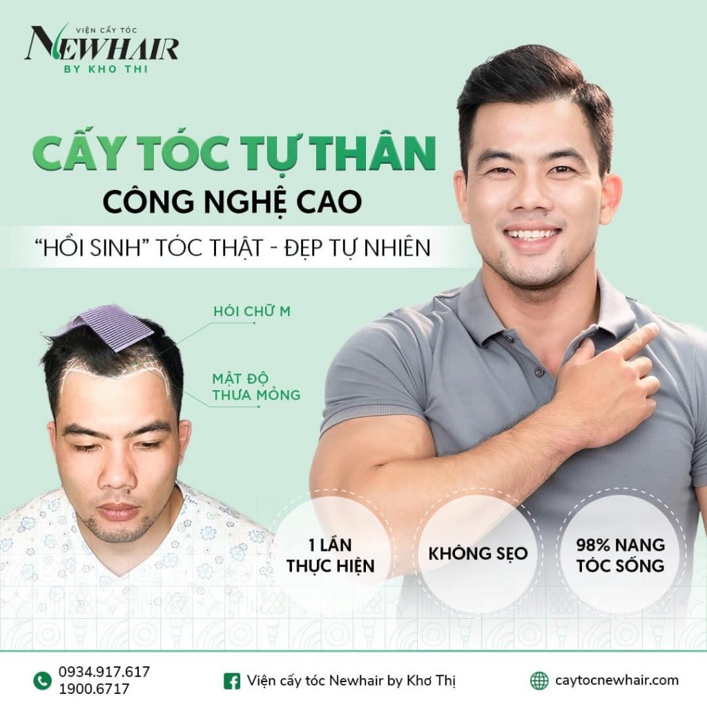 Có nên cấy tóc tự thân