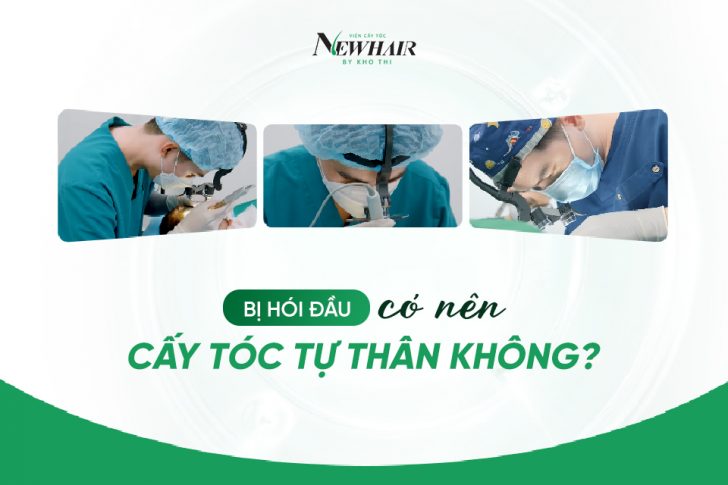 Có nên cấy tóc tự thân